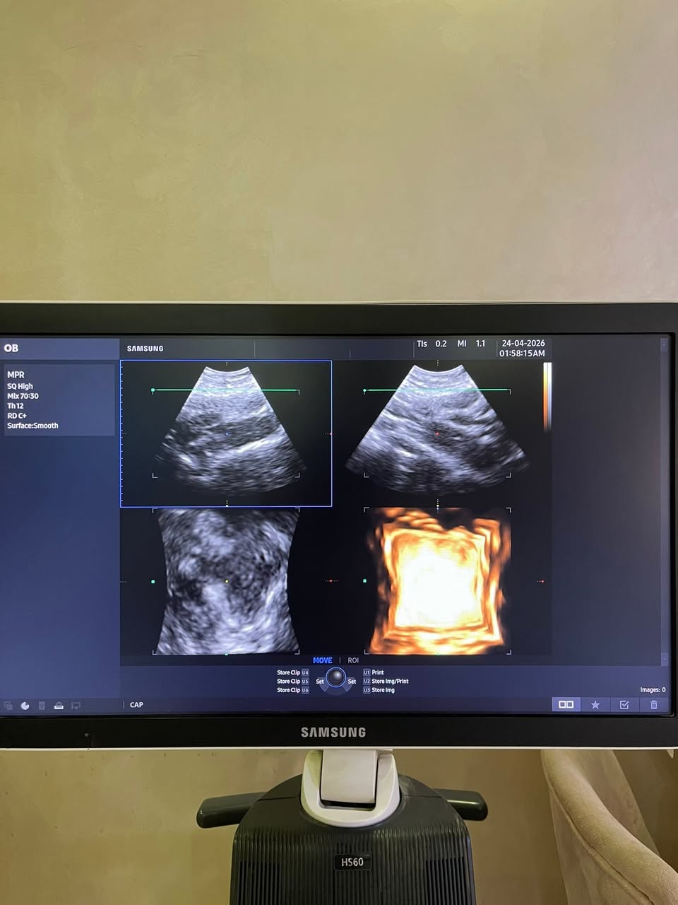 للبيع Samsung V5-9 4D Vaginal Probe — صورة 4 من 5